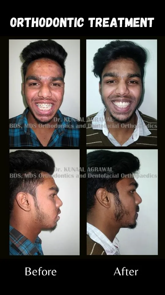 braces before and after bhopal 15